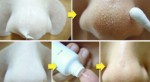 Mụn đầu đen sẽ biến mất trong “tích tắc” với cách thức đơn giản này