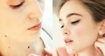 10 nốt ruồi đen đủi cần cân nhắc xóa bỏ trước khi quá muộn