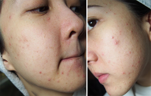 Cách trị mụn nhọt hiệu quả ngay lần đầu tiên với chiêu ‘độc đáo’ này
