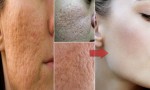 Giảm đáng kể lỗ chân lông to với phương pháp tự nhiên