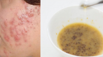 Sạch trơn mụn trong 1 đêm bằng những thứ có sẵn trong bếp nhà bạn