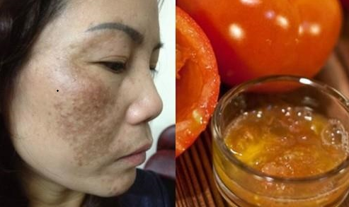 Trị nám da chưa bao giờ rẻ và đơn giản hơn công thức 1k/ngày này