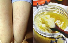 Cách trị triệt để các đốm thâm ở chân tha hồ mặc váy ngắn