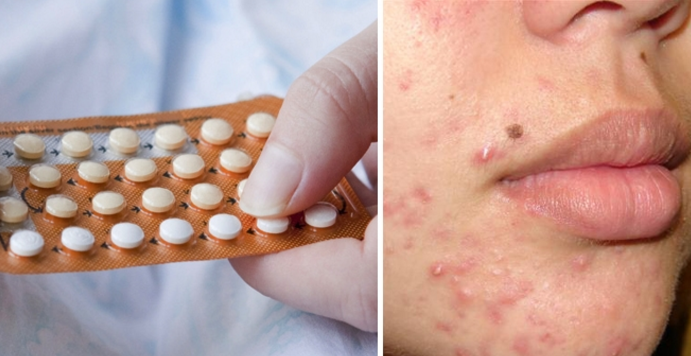 Một thiếu nữ suýt mất mạng vì dùng thuốc tránh thai để trị mụn