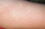 Công thức trị sạch viêm nang lông hiệu quả 100% chỉ bằng nguyên liệu rẻ tiền