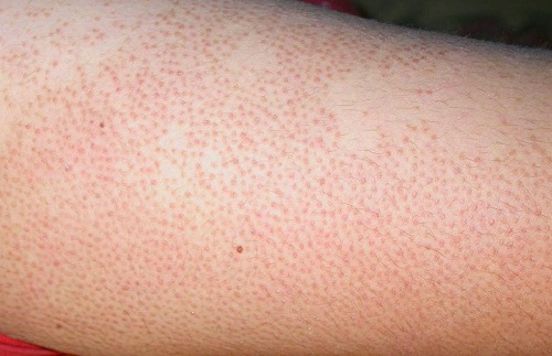 Công thức trị sạch viêm nang lông hiệu quả 100&permil; chỉ bằng nguyên liệu rẻ tiền