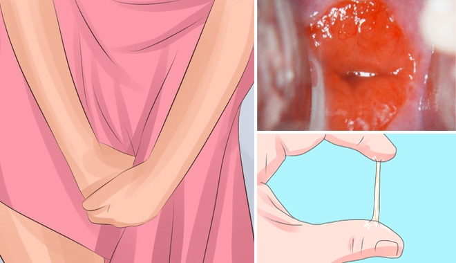 Có những biểu hiện này, chị em có nguy cơ mắc bệnh xói mòn tử cung