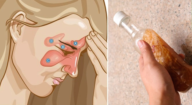 Viêm xoang lâu năm cũng hết ngay lập tức khi dùng hỗn hợp này