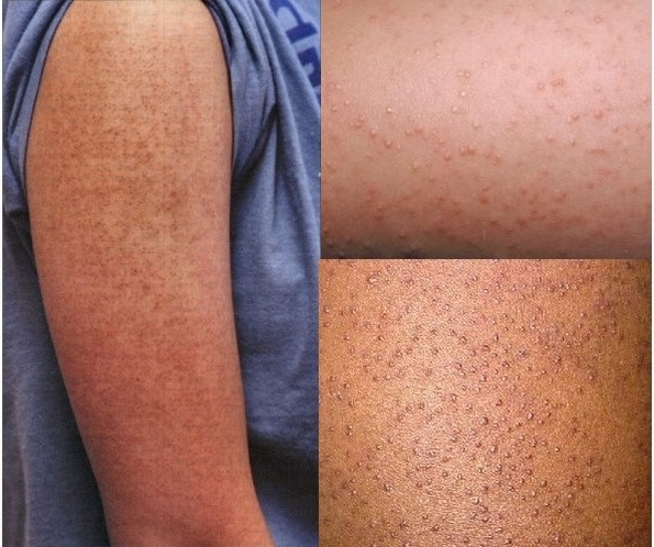 ÁC MỘNG MANG TÊN “DA GÀ” VÀ PHƯƠNG PHÁP TRỊ LIỆU KHÔNG CẦN DÙNG THUỐC