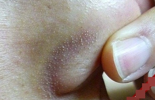 Xóa bỏ mụn cám dày đặc, trắng xóa chỉ sau 1 tuần