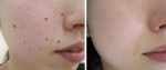 Cách tẩy nốt ruồi đơn giản và hiệu quả cực cao bằng tỏi và hành tây