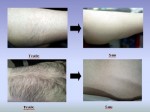 Cách triệt lông vĩnh viễn không mọc lại, không đau, không rát
