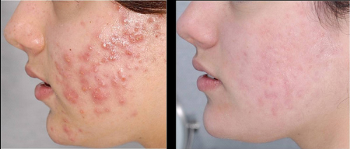 Công thức trị mụn bọc “ngon lành” ai làm cũng mê từ lá rau ngót