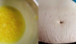 “Thần dược” là phẳng rạn da vùng bụng, hông, đùi hiệu quả 100‰
