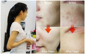 Chia sẻ cách trị mụn tốt nhất cho làn da người Việt