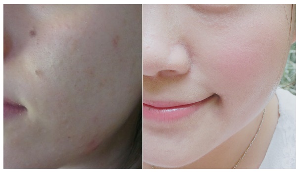 Tự làm mặt nạ "gột" sạch 100&permil; mụn, dưỡng da trắng hồng rạng rỡ ngay tại nhà