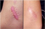 Muốn loại bỏ sẹo trên cơ thể thì hãy làm những cách sau