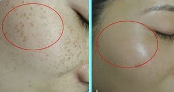 3 công thức trộn mặt nạ trà xanh làm mờ thâm nám, tàn nhang hiệu quả