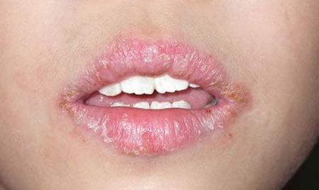 Chế thần dược “cứu” bờ môi thâm, nứt nẻ tại nhà