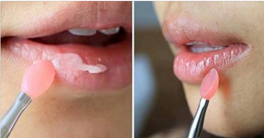 Môi thâm bẩm sinh cũng sẽ hết ngay sau 1 đêm, hãy thử ngay
