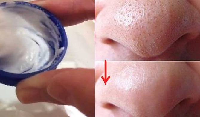 Thoa thứ này lên mũi 2 phút, mụn đầu đen sẽ sạch boong không cần nặn