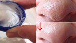Thoa thứ này lên mũi 2 phút, mụn đầu đen sẽ sạch boong không cần nặn
