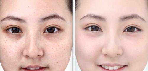 Gừng tươi – “ông vua” trị nám và tàn nhang cho phái đẹp