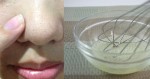 Bạn sẽ tiếc cả đời nếu không biết 4 công thức trị mụn, da sáng mịn này