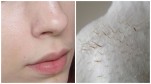 Chỉ cần đắp thứ này lên, mụn cám dù ít hay nhiều cũng bị "đánh bại" hoàn toàn sau 1 tuần