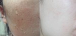 Đánh bay sẹo thâm hiệu quả đến 99% nhờ những nguyên liệu ‘’lạ mà quen’’