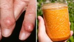 THỨC UỐNG KỲ DIỆU ĐẨY LÙI BỆNH GOUT AI CŨNG CÓ THỂ TỰ LÀM