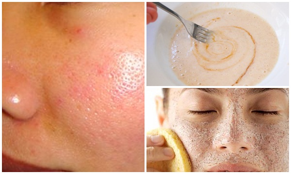 Tạm biệt lỗ chân lông to trên mặt với những cách đơn giản sau