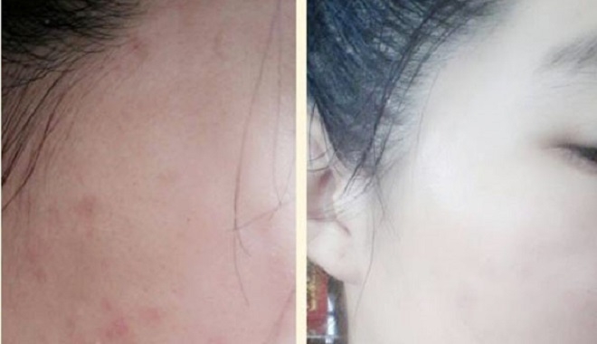 Tôi đã hết hoàn toàn mụn ẩn dưới da chỉ trong 14 ngày