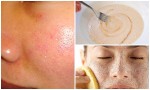 Tạm biệt lỗ chân lông to trên mặt với những cách đơn giản sau