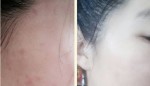Tôi đã hết hoàn toàn mụn ẩn dưới da chỉ trong 14 ngày