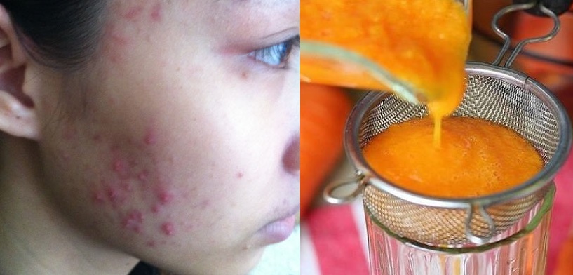 Mụn bao nhiêu cũng giảm dần hết chỉ trong 2 tuần với hỗn hợp này