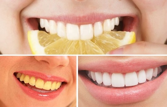 Tẩy sạch cao răng chỉ trong 5 phút với bí quyết nhỏ