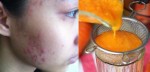 Mụn bao nhiêu cũng giảm dần hết chỉ trong 2 tuần với hỗn hợp này