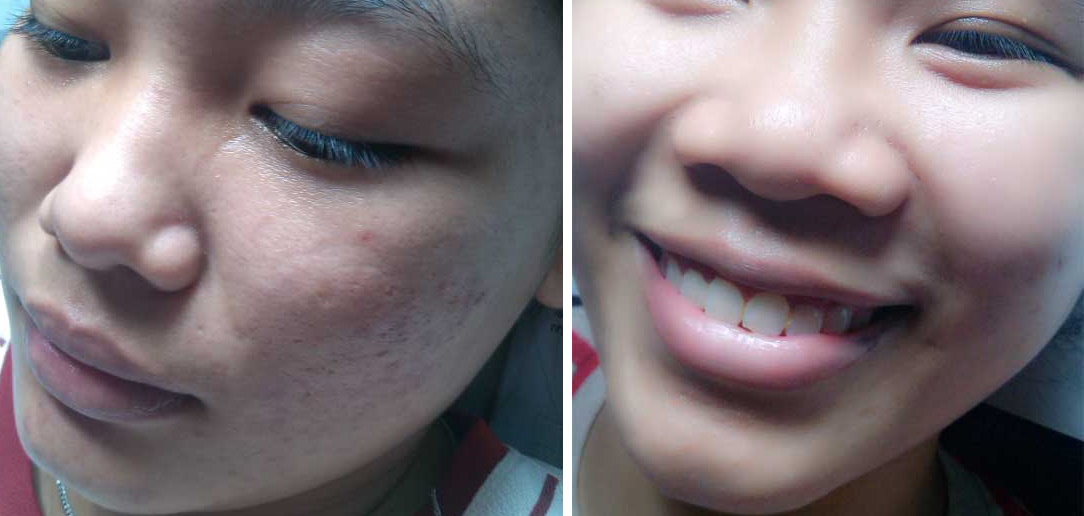 Da sáng trắng bất ngờ sau 7 ngày chỉ với mặt nạ cà chua "thần thánh"