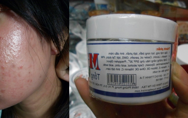 Da mặt hóa da cóc vì dùng kem trắng da ‘siêu tốc’