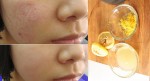 Chắc chắn sẽ xóa thành công vết sẹo chỉ trong 2 tuần