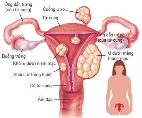 Nhiều phụ nữ bị u xơ tử cung mà không biết