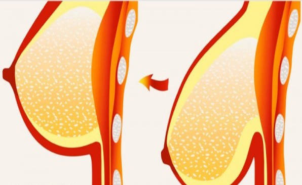 Làm 1 tuần/lần: vòng 1 chảy xệ cũng săn chắc như gái đôi mươi