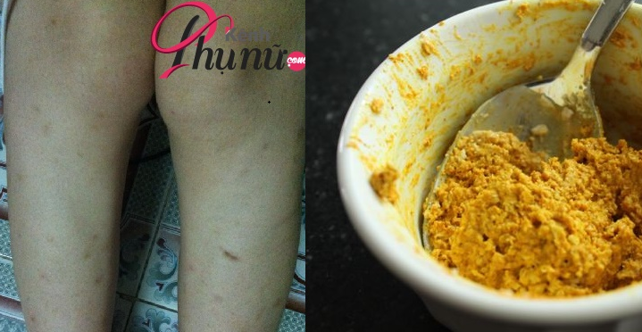 Chân chi chít vết thâm cũng trở nên trắng mịn nhờ hỗn hợp quen thuộc này
