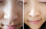 Mụn đầu đen lổm chổm đầy mặt cũng phải đầu hàng trước bàn chải đánh răng