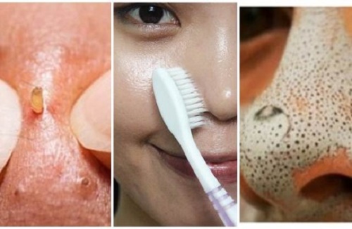 “Quét sạch” mụn đầu đen sau 1 đêm chỉ với 1 chiếc bàn chải