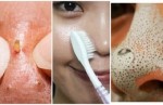 “Quét sạch” mụn đầu đen sau 1 đêm chỉ với 1 chiếc bàn chải