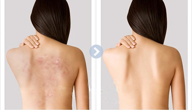 Chia tay với mụn lưng với công thức bã cà phê + đường
