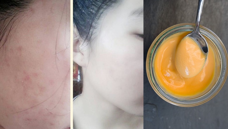 1 tuần dùng công thức này, mụn nào cũng bị xóa sổ hoàn toàn