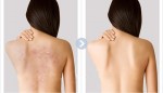 Chia tay với mụn lưng với công thức bã cà phê + đường